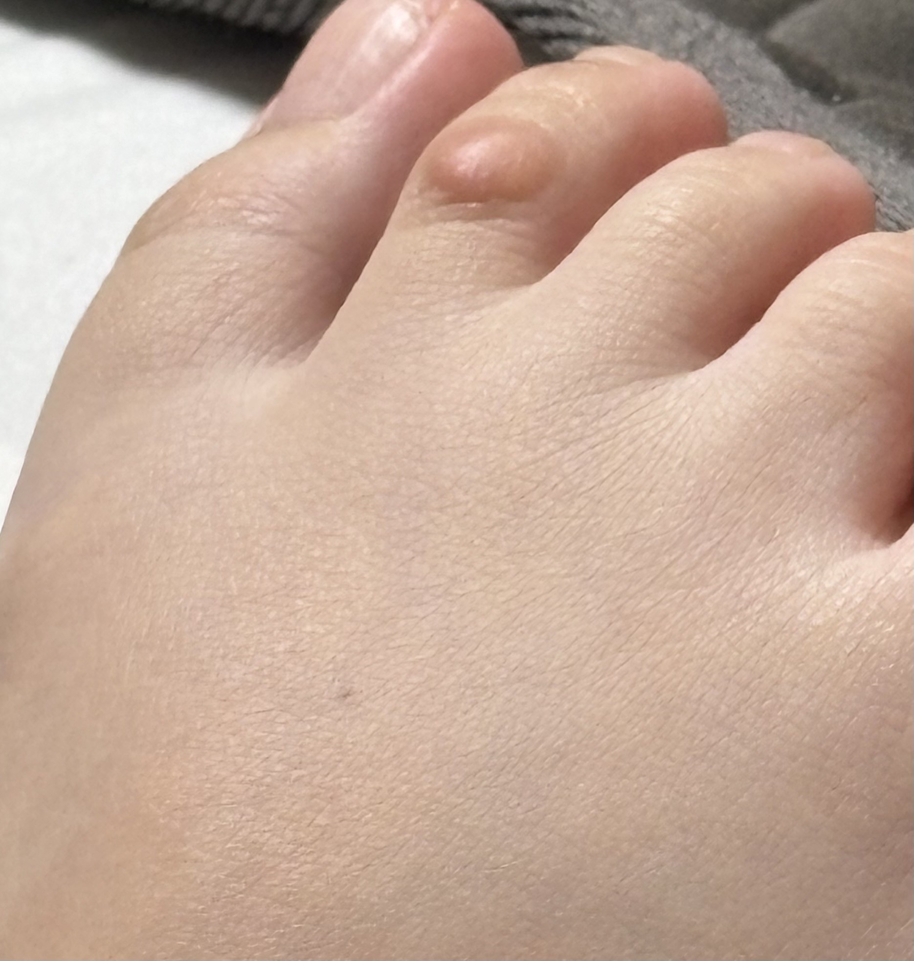 [잡담] 한쪽 발가락에만 동그란 물집낫는데 티눈이야 사마귀야 머야 하 | 인스티즈