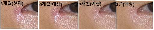 [잡담] 앞트임 복원 3개월차 빛흉 고민 | 인스티즈