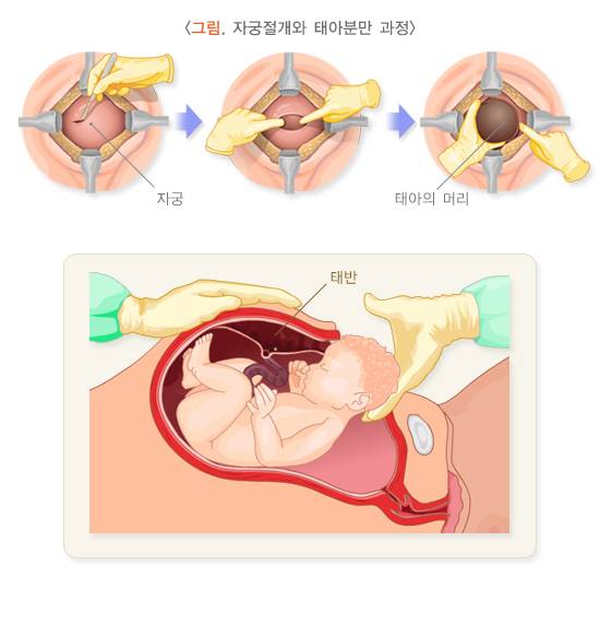 [잡담] 너네 재왕절개 이거 알고 있었음? | 인스티즈