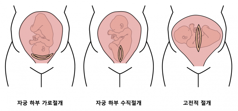 [잡담] 너네 재왕절개 이거 알고 있었음? | 인스티즈