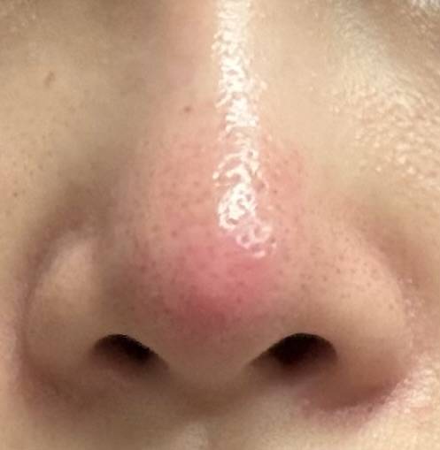 [잡담] 가짜콘데 코끝에 여드름 날때마다 무서워 죽겠듬 | 인스티즈