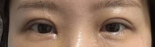 [잡담] 쌍수 경과 봐줄 익ㅠㅠ | 인스티즈