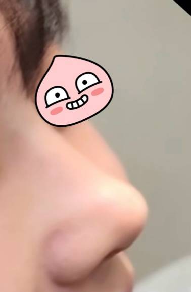 [잡담] 코수술 하고싶어 | 인스티즈