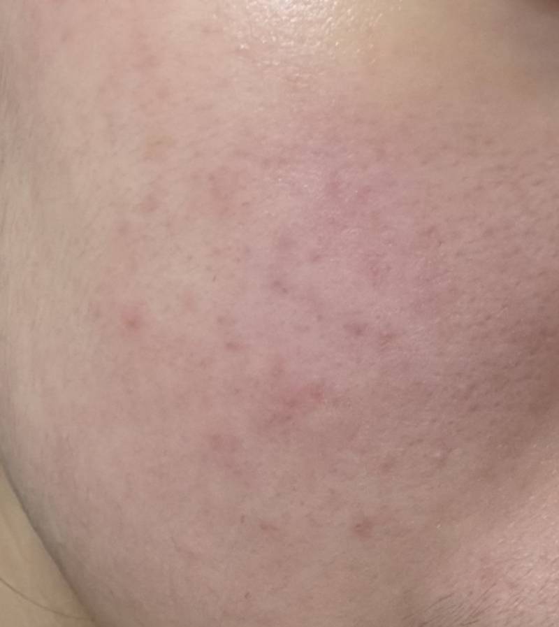 [잡담] 피부 좀 좋아진거 맞ㄷ지...? | 인스티즈