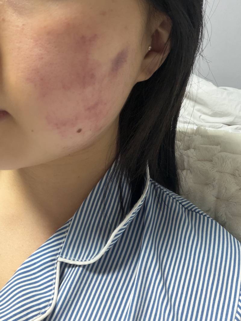 [잡담] 인모드+리니어지리프팅 받고 왔는데 | 인스티즈