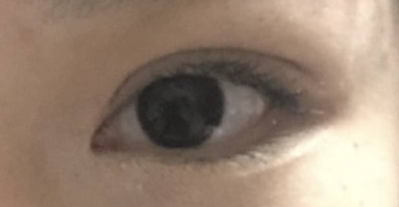 [잡담] 쌍수 쌍커풀이 있다는 느낌보다는 그냥 지방이 뭉쳐있는 것 같은데 | 인스티즈