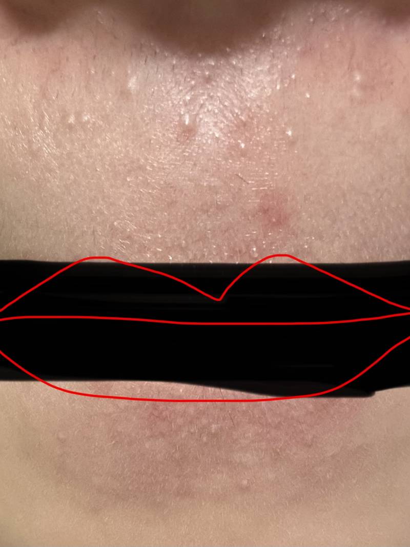 [잡담] 인중에 갑자기 이런거 생겼는데 어떻게해야돼??? 사진주의!!! | 인스티즈