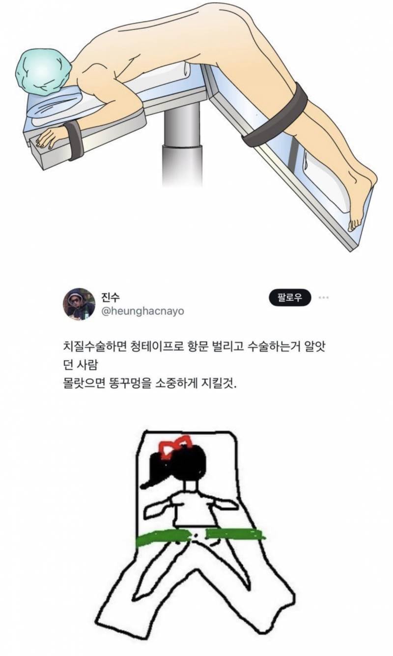 [잡담] 수술 없이 응꼬 건강 지키는법 (feat.치질) | 인스티즈