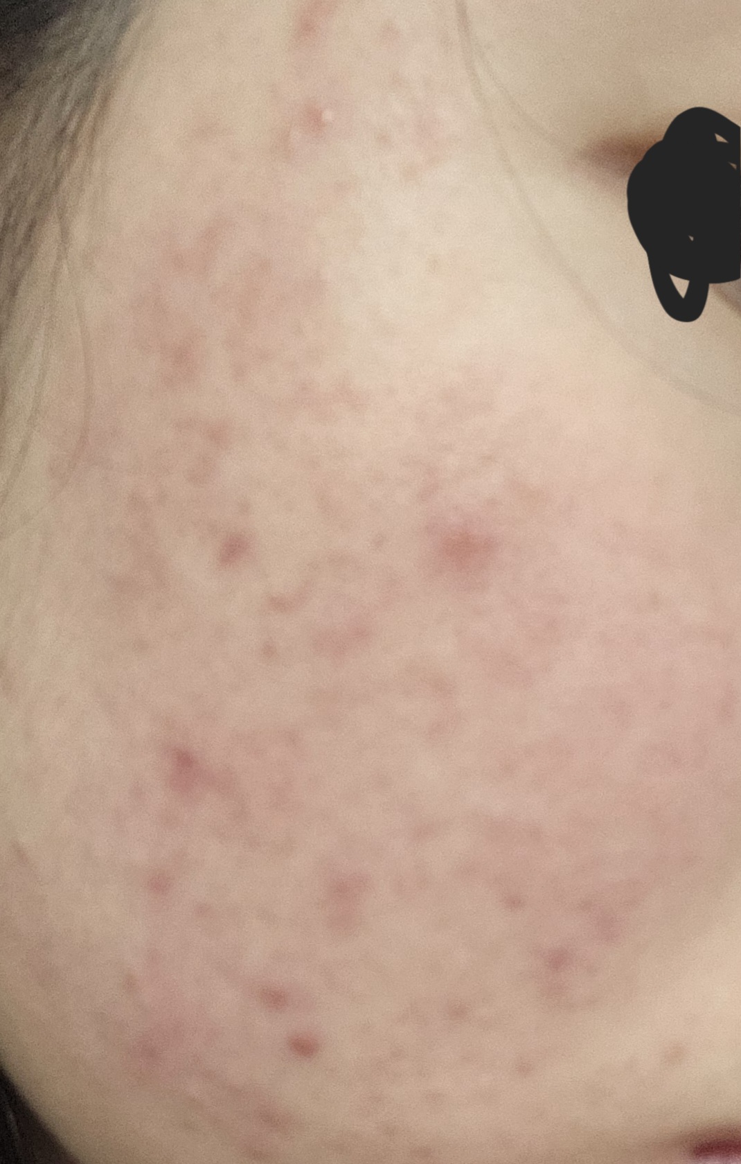 [잡담] 혐주의) 이런 여드름 피부는 피부과 없인 치료가 어려울까...? | 인스티즈