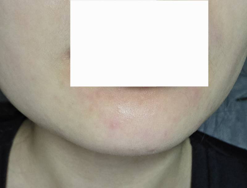 [잡담] 턱에 빨갛고 오돌토돌하게 되면 머 바르는게 좋아? | 인스티즈
