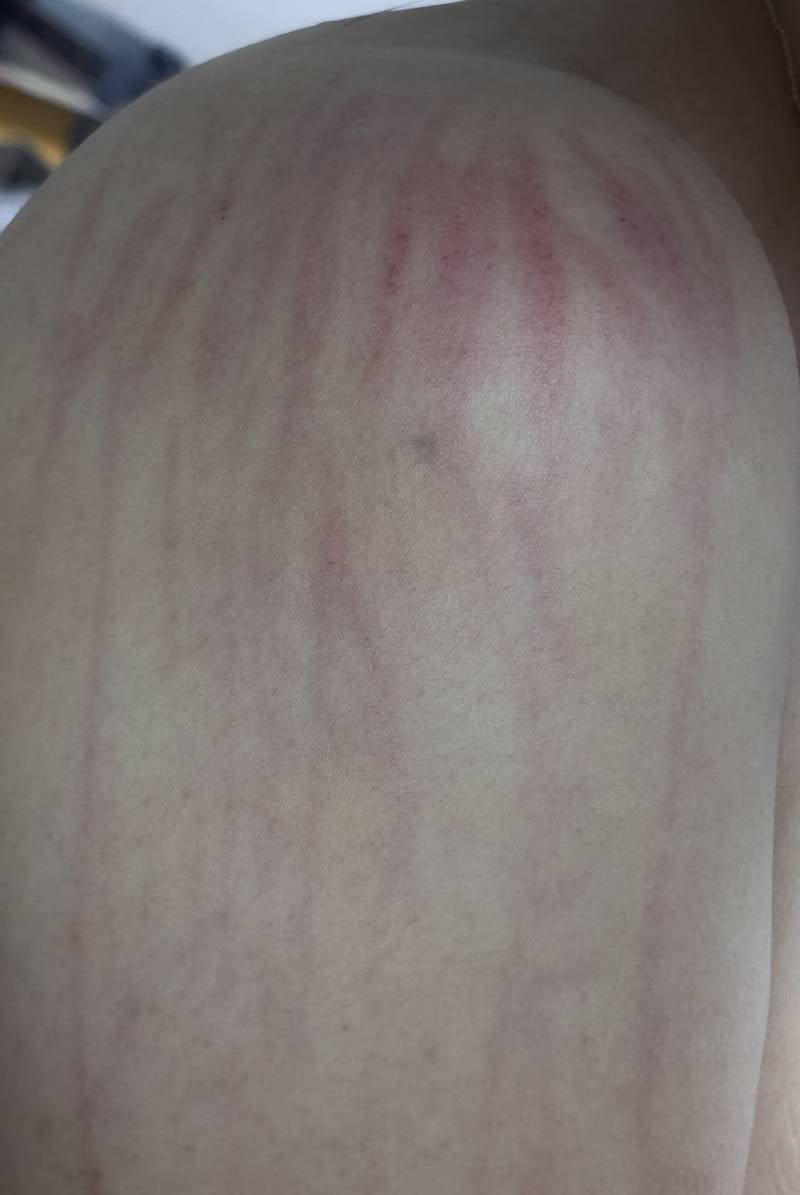 [잡담] (제발)가려움증 극복한 익 있어 !!!!!??????? ㅎㅇㅈㅇ | 인스티즈