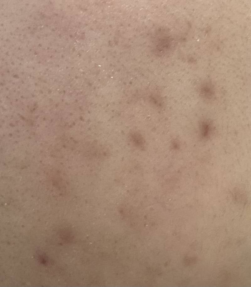 [잡담] 색소침착은 도대체 어떻게 없애는걸까 | 인스티즈