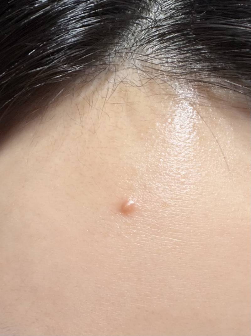 [잡담] 여드름 잘 알들있니? (뾰루지?) | 인스티즈