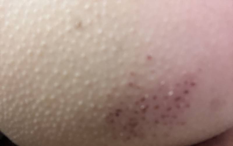 [잡담] 이거피부왜이럼거야 | 인스티즈