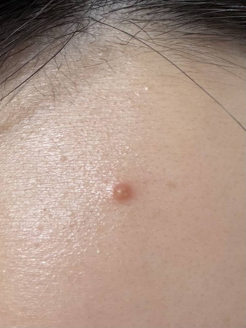 [잡담] 여드름에 니들패치 붙여본 익 있어? (약 ㅎㅇㅈㅇ) | 인스티즈