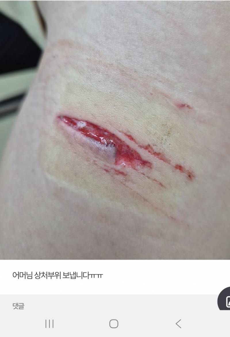 [잡담] 아니 울언니 용인 처인구 역북동 사는데 애가 어린이집에서 다쳐서왔는데 (혐오주의) | 인스티즈