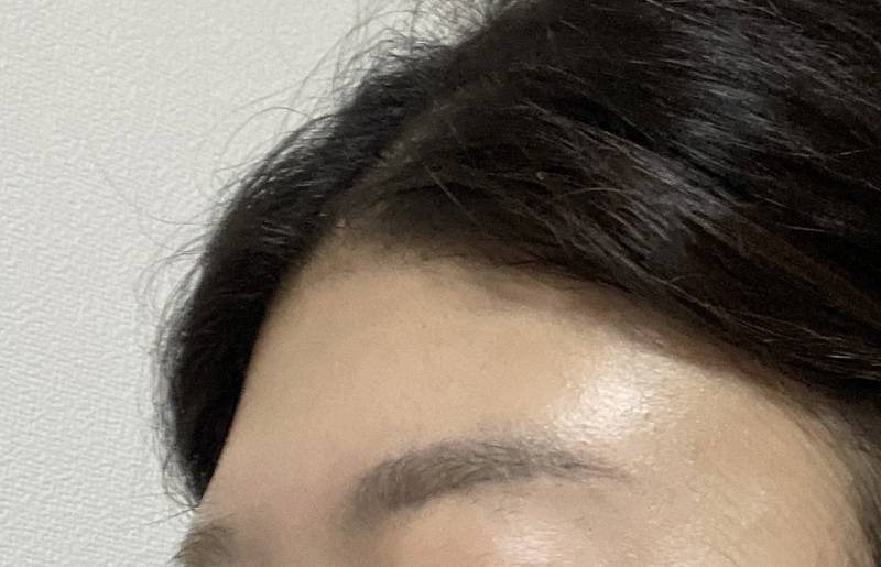 [잡담] 이마 많이 납작한 편이지? 필러 추천해? | 인스티즈