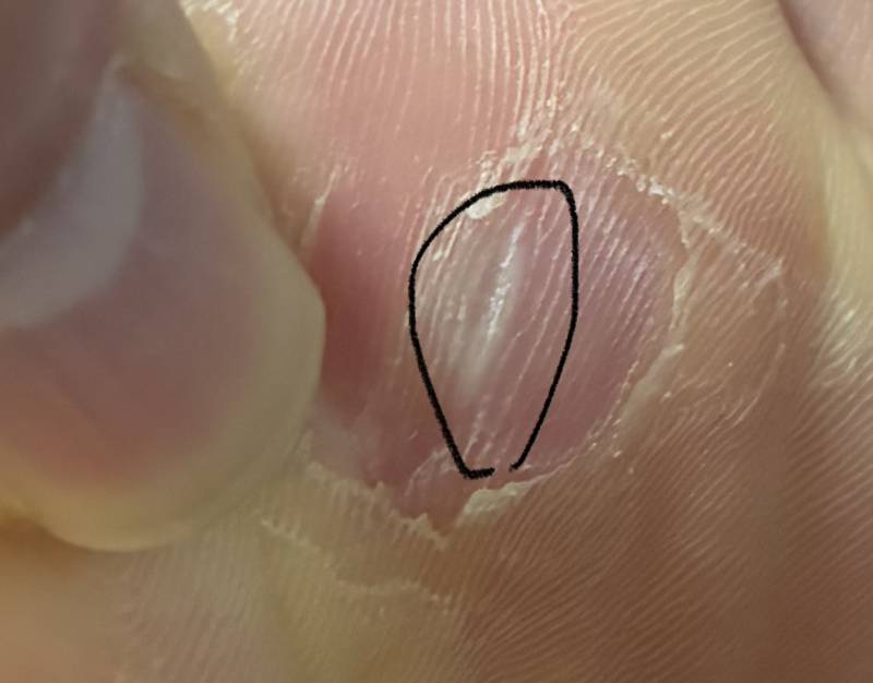 [잡담] 티눈 밴드랑..액상 바른지 이주짼데..아직 전부 안벗겨진것 같지? 발사진 주의.. | 인스티즈