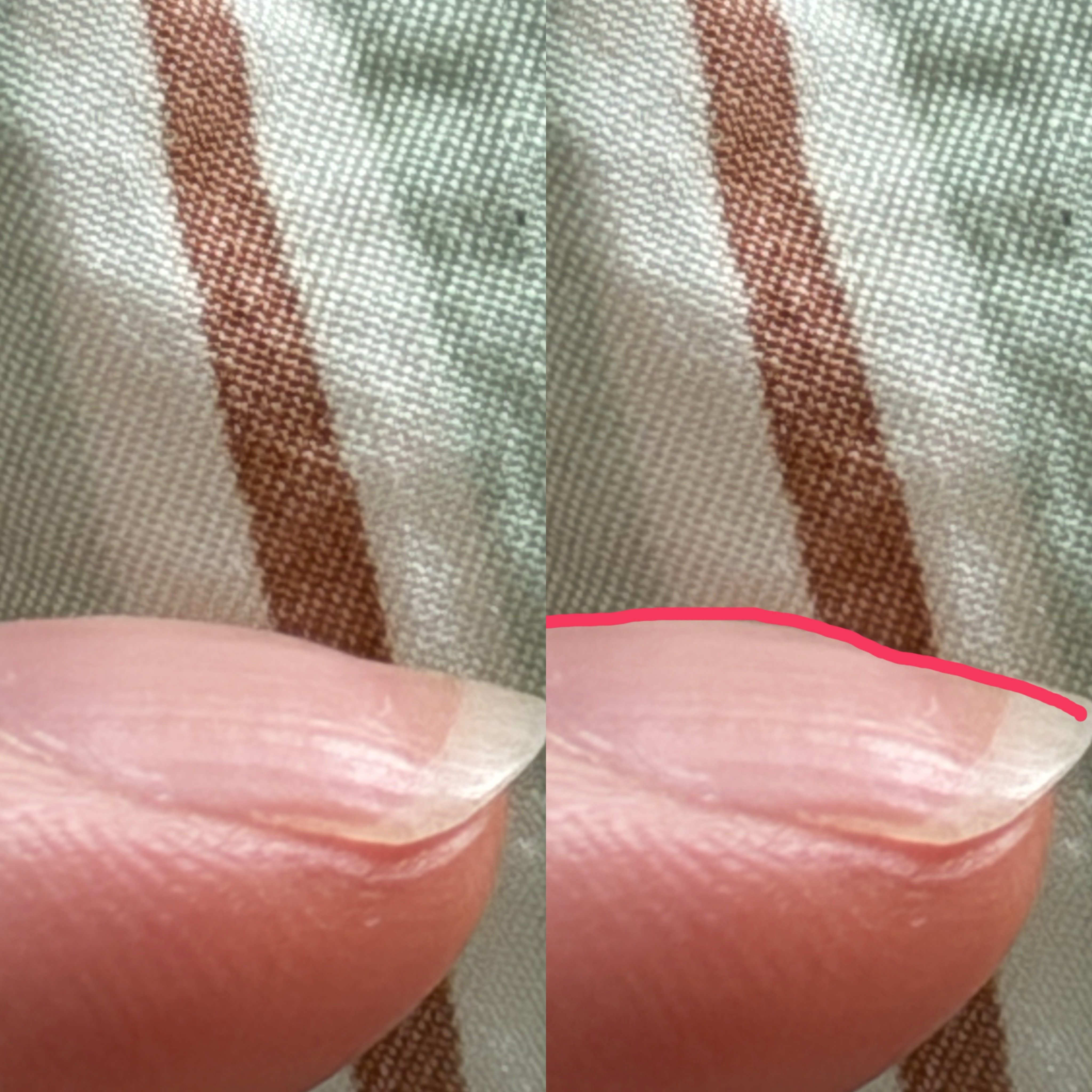 [잡담] 손톱 표면 울퉁불퉁한 것도 복구되나? ㅜㅜ | 인스티즈