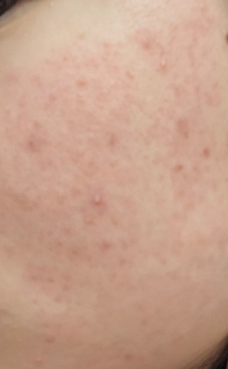 [잡담] 혐주의) 여드름 피부 고민있어 ㅠ | 인스티즈