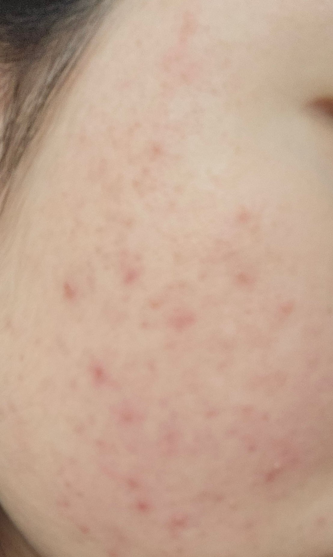 [잡담] 혐주의) 여드름 피부 고민있어 ㅠ | 인스티즈