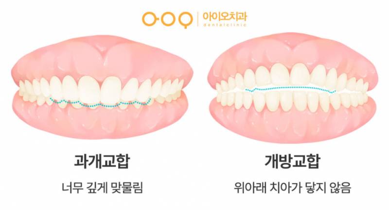 [잡담] 턱 짧은편인데 교정했는데 | 인스티즈