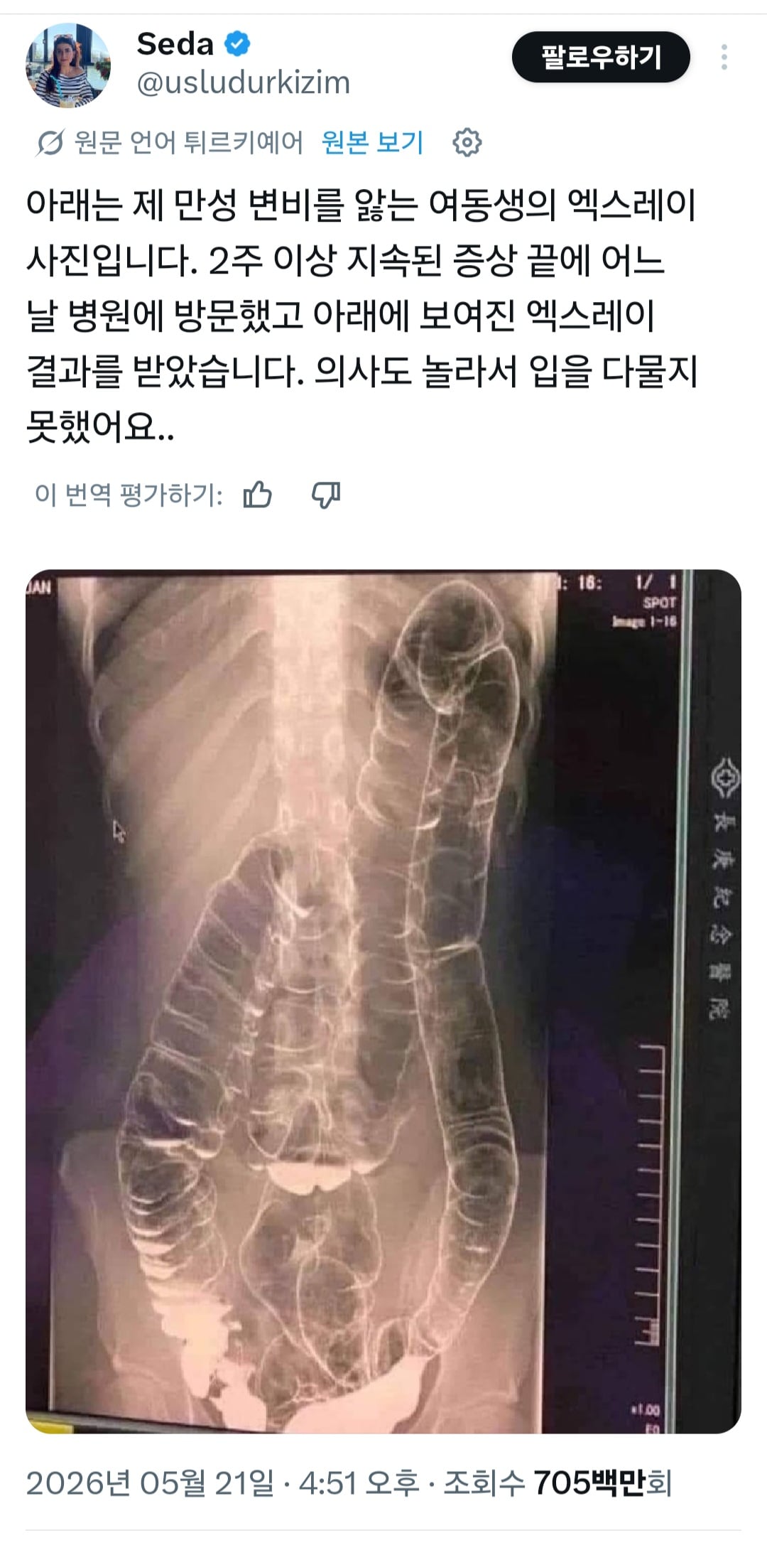 [잡담] 2주 이상 똥 못 싼 사람의 엑스레이래... | 인스티즈