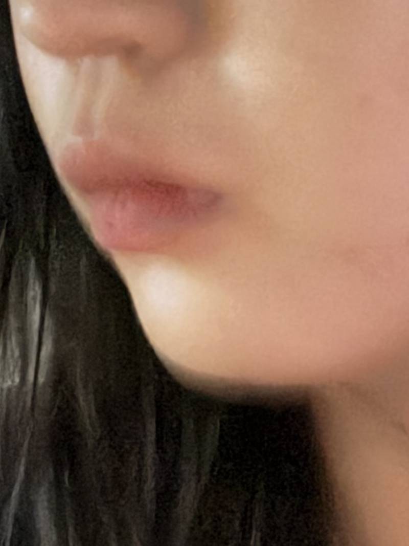 [잡담] 턱끝필러 맞을까 말까 판단해줄사람 | 인스티즈