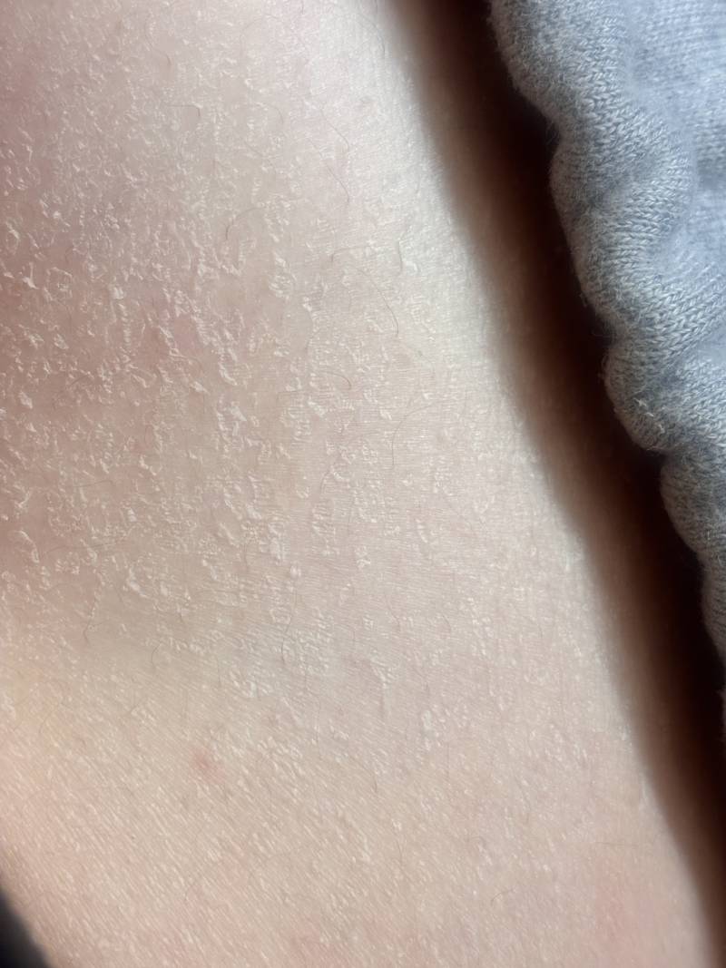 [잡담] ㅎㅇㅈㅇ 몸 피부에 건조해서 각질?? 일어나는데 이거 어케해 | 인스티즈