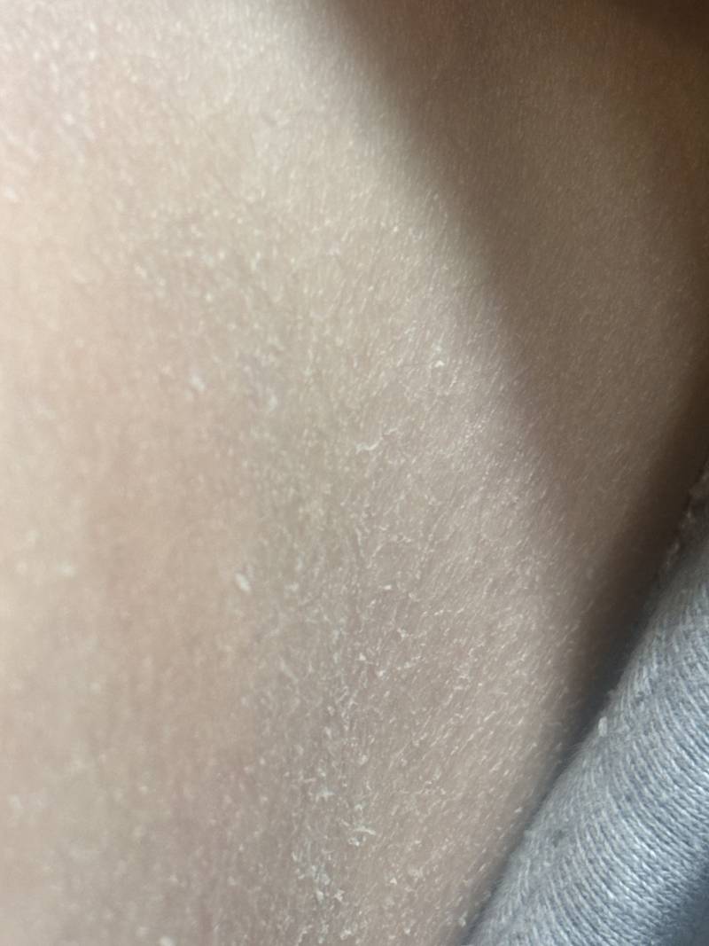 [잡담] ㅎㅇㅈㅇ 몸 피부에 건조해서 각질?? 일어나는데 이거 어케해 | 인스티즈