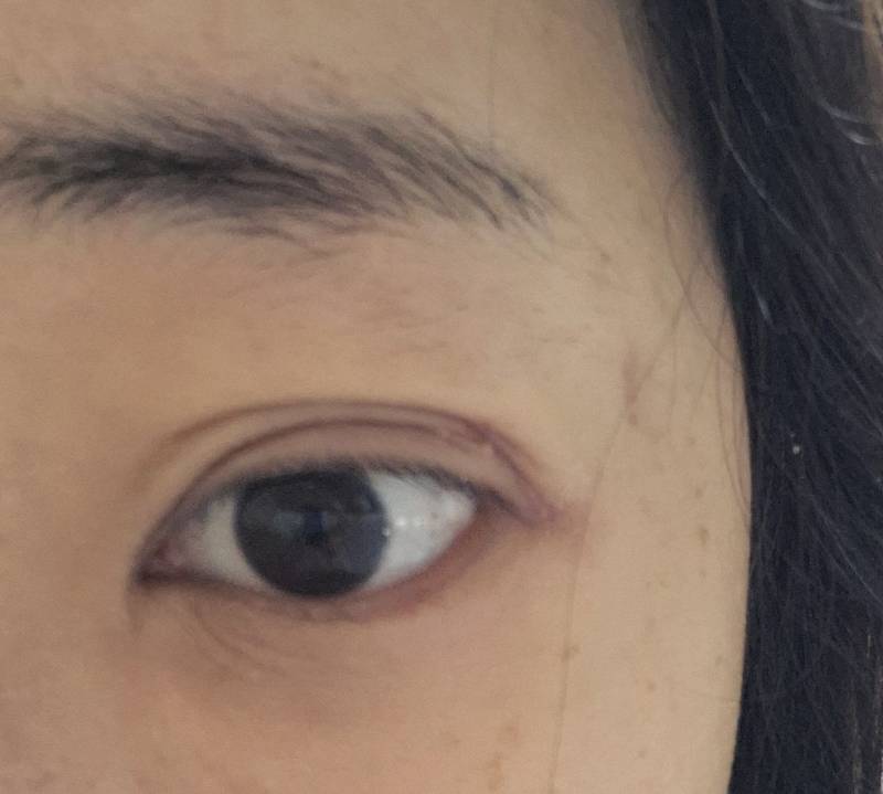 [잡담] 눈 부었는데 겹쌍이 되서 안 사라져 (사진있음) | 인스티즈