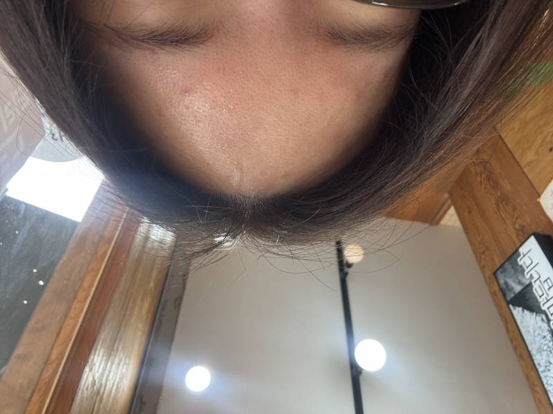 [잡담] (혐오주의) 이런 붉은기 도는 피부는 무슨 레이저 해야돼? ㅜㅜ | 인스티즈