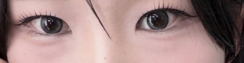 [잡담] 나 눈밑지방재배치 하는게 낫겠지? | 인스티즈