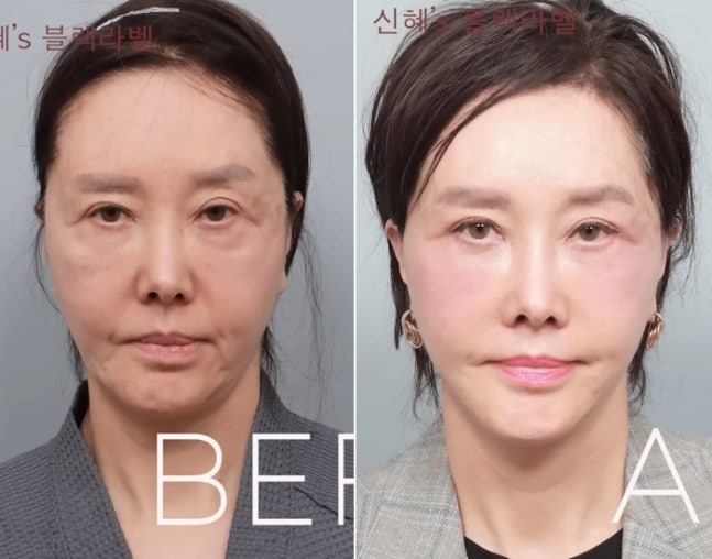 [잡담] 유혜리 배우 안면거상 전후 공개했는데 | 인스티즈