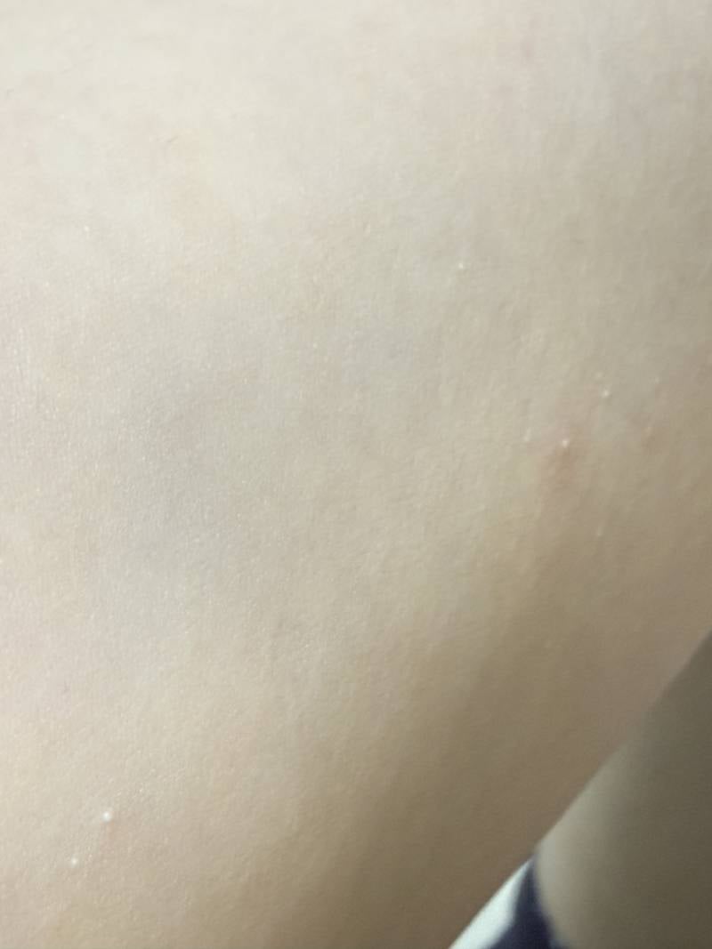 [잡담] 팔에 하얀색 좁쌀같은거 났는데 뭔지 아는사람,, | 인스티즈