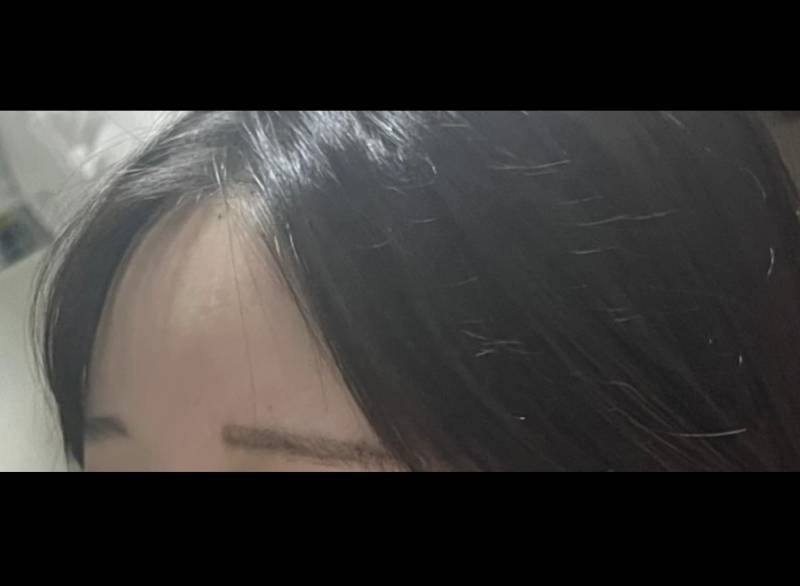 [잡담] 이마지방이식 전 후 차이 보고 가 !!!!! | 인스티즈
