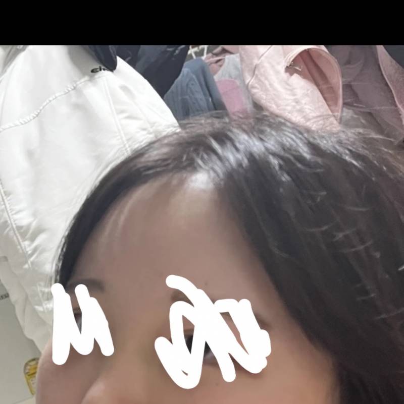 [잡담] 이마지방이식 전 후 차이 보고 가 !!!!! | 인스티즈