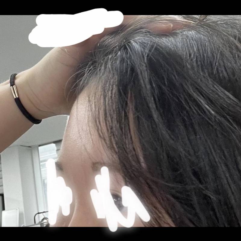 [잡담] 이마지방이식 전 후 차이 보고 가 !!!!! | 인스티즈