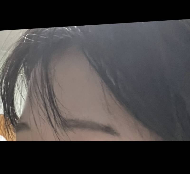 [잡담] 이마지방이식 전 후 차이 보고 가 !!!!! | 인스티즈