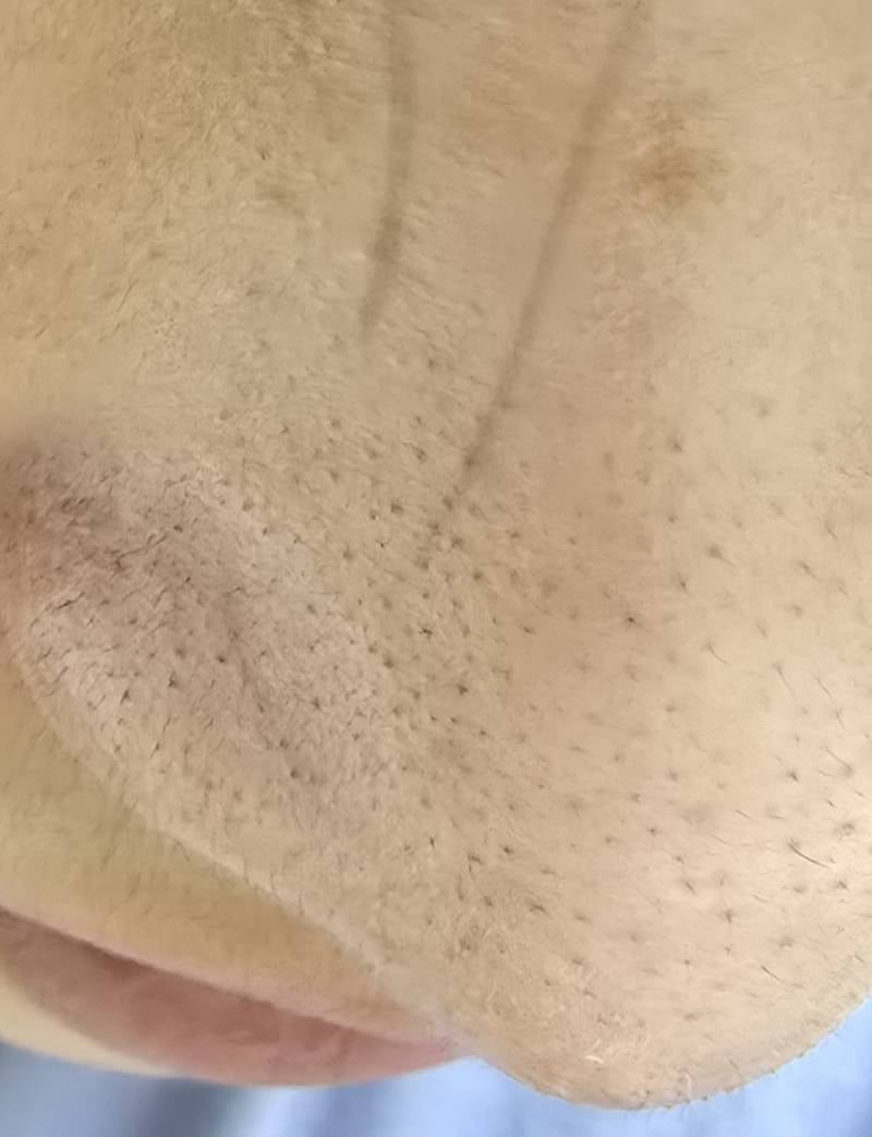 [잡담] 혐오주의) 블랙헤드 나보다 심한사람 못본듯 | 인스티즈