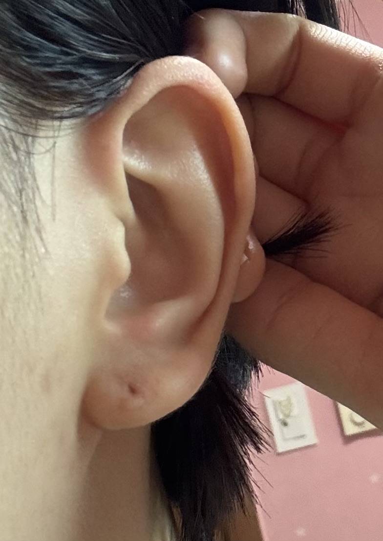 [잡담] 이런 경우 귀 막혔을때까지 기달렸다가 다시 뚫는게 낫나? | 인스티즈