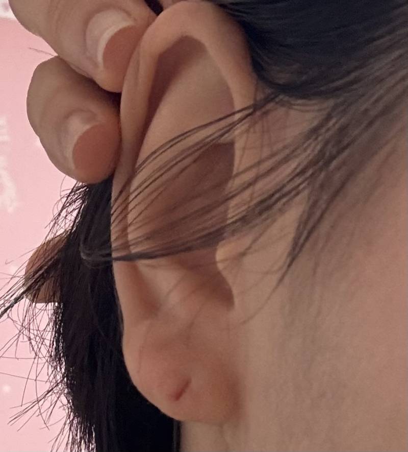 [잡담] 이런 경우 귀 막혔을때까지 기달렸다가 다시 뚫는게 낫나? | 인스티즈