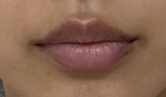 [잡담] 입술필러 5일차인데 비포 에프터 차이가 있는지 봐줘👄💉 | 인스티즈