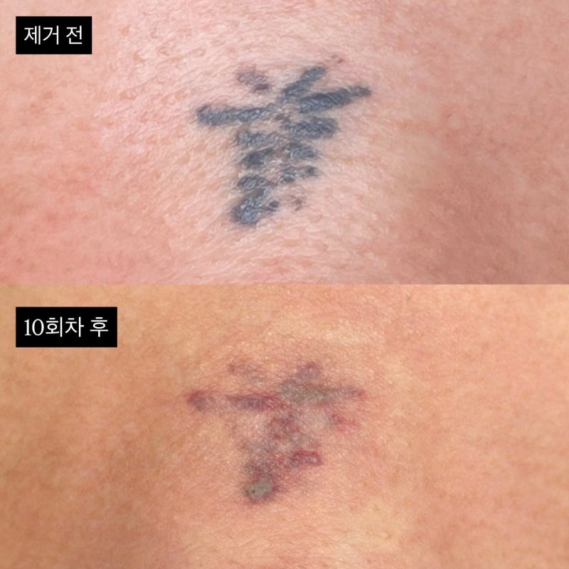 [잡담] (혐)타투 지우려고 고민중인데 10회를 제거해도 이정도래 | 인스티즈