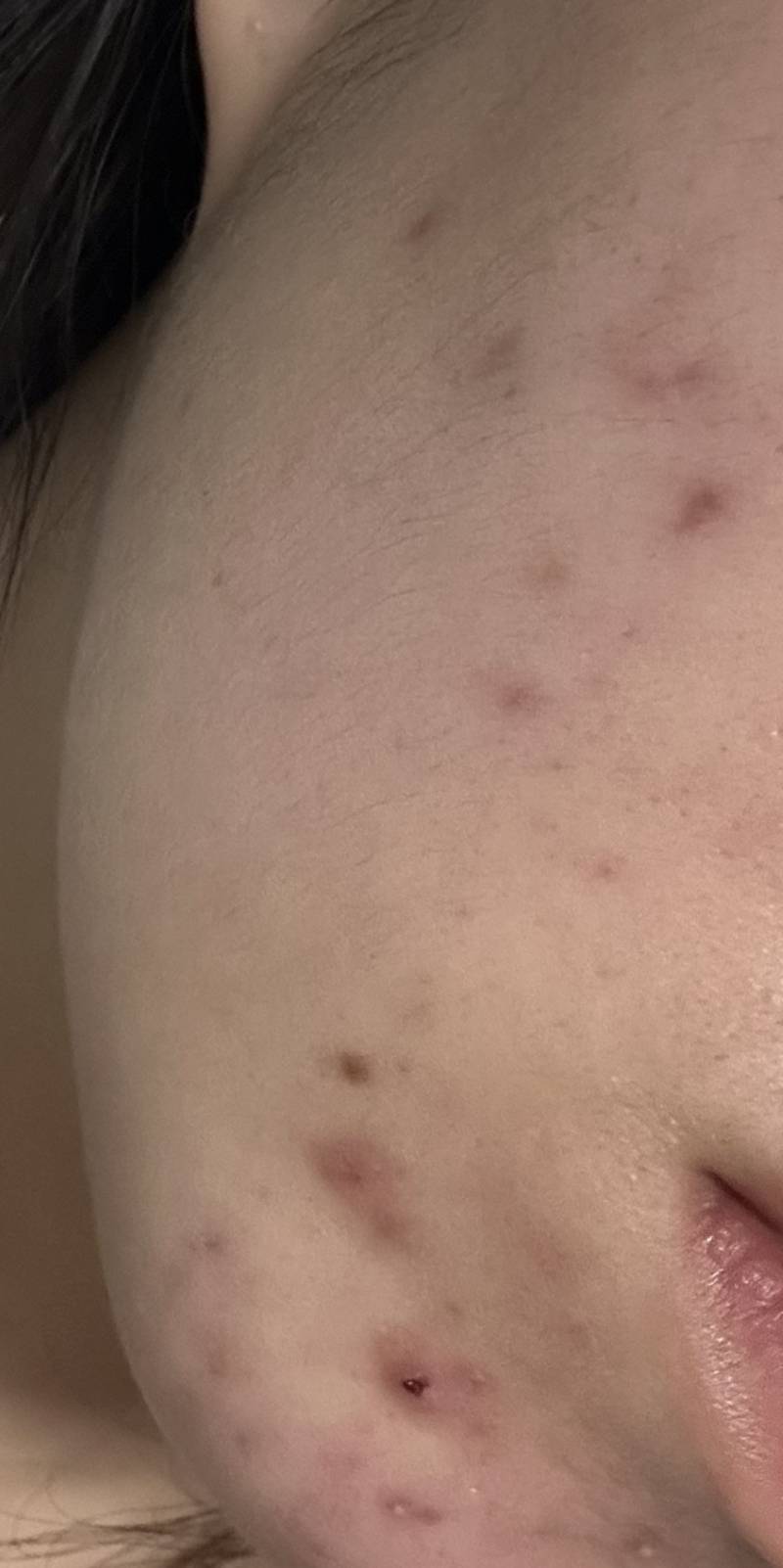 [잡담] 성인여드름때매 죽고싶은데 이거 평생 못 없애? 사진있음😭 | 인스티즈