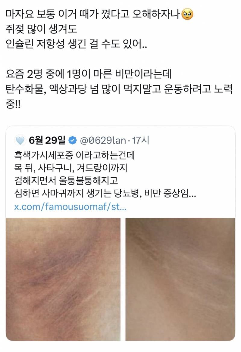 [잡담] 혹시 사타구니 이정도로 심한 익 있음? | 인스티즈