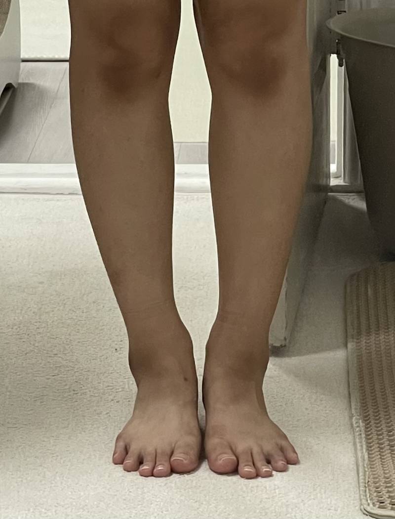 [잡담] 종아리보톡스 맞지 말라고 하지만 맞는 이유ㅋㅋ 차이 봐 | 인스티즈