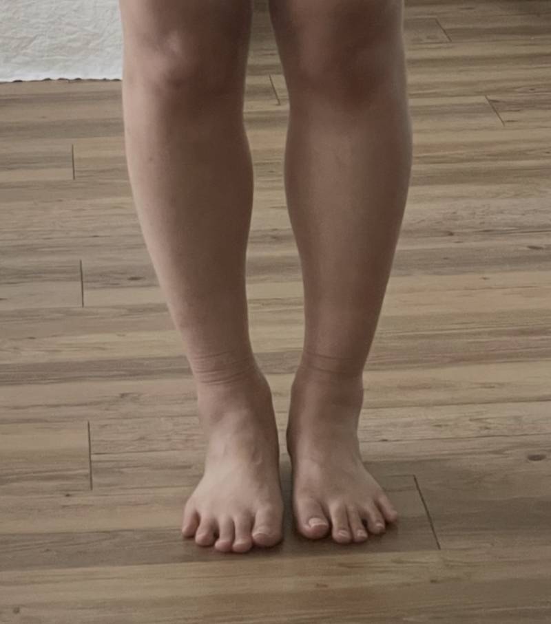 [잡담] 종아리보톡스 맞지 말라고 하지만 맞는 이유ㅋㅋ 차이 봐 | 인스티즈