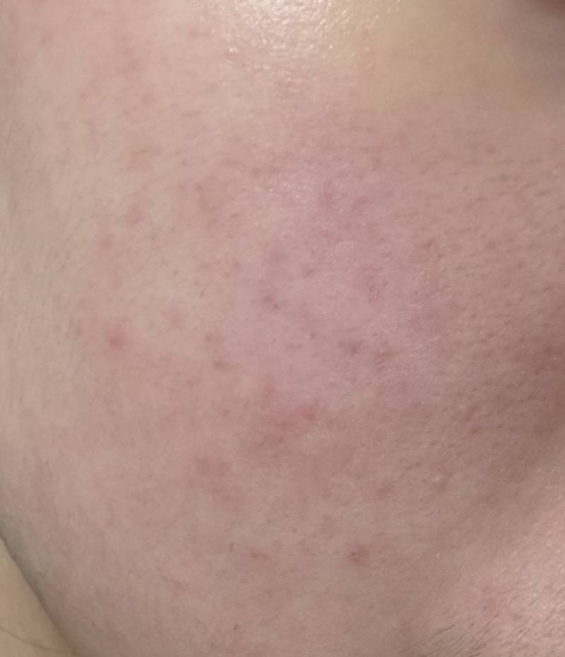 [잡담] 그래도 피부 마니 좋아졌다...ㅠ | 인스티즈