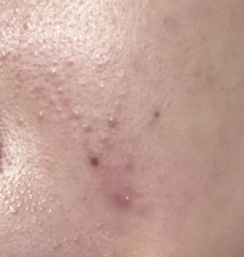 [잡담] 그래도 피부 마니 좋아졌다...ㅠ | 인스티즈